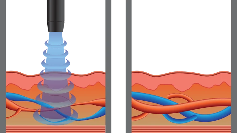 Shockwave Therapy Effect on ED in Charlotte